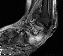 Diabetic Heel Abscess MRI